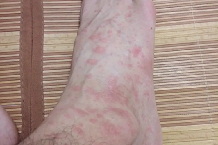 皮肤过敏红肿脚背疙瘩图 皮肤过敏红肿脚背疙瘩图