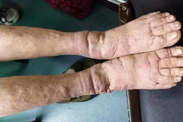 胫前黏液性水肿脚背症状图