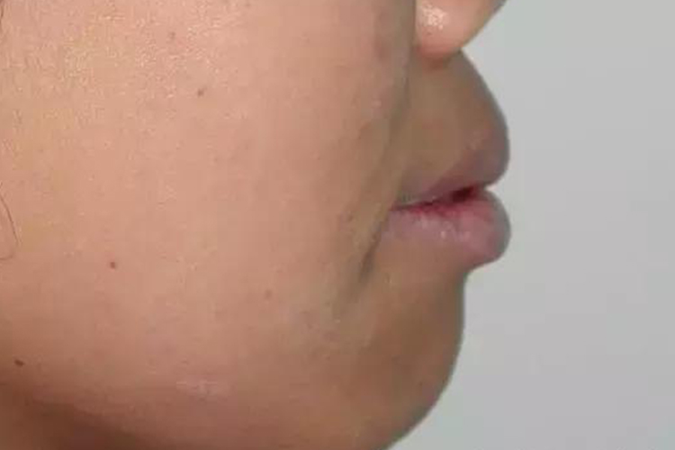 Binder综合征下颌前凸图 Binder综合征下颌前凸图