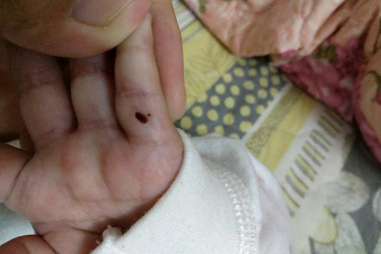 黑色素瘤宝宝手指长小黑点图