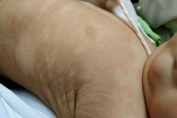 婴儿白色糠疹图