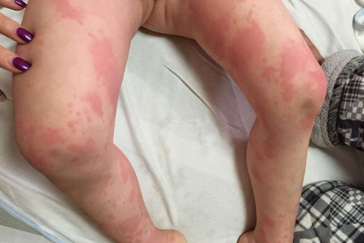 茶叶过敏腿部症状图