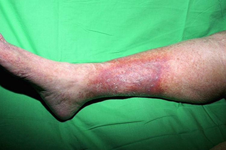 硬化性脂膜炎小腿症状图 硬化性脂膜炎小腿症状图