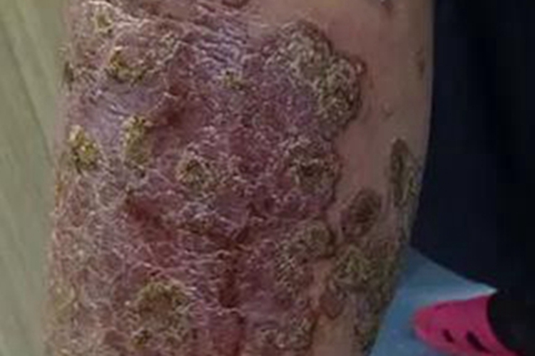 泛发性脓疱型银屑病胳膊症状图