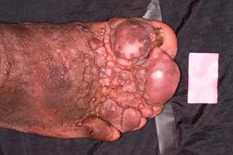 丝虫病脚部疙瘩图