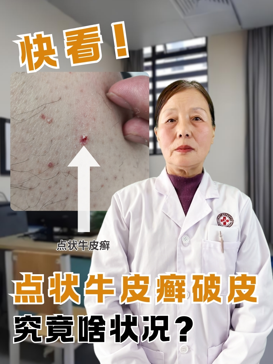 快看!点状牛皮癣破皮,究竟啥状况?