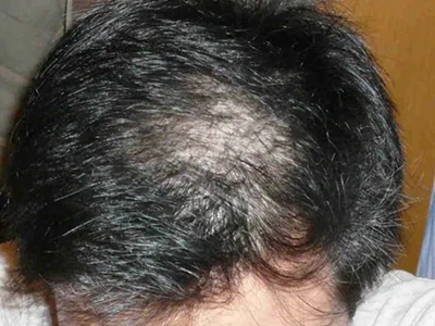 梅毒性脱发头发中间稀少能看见头皮图.jpg