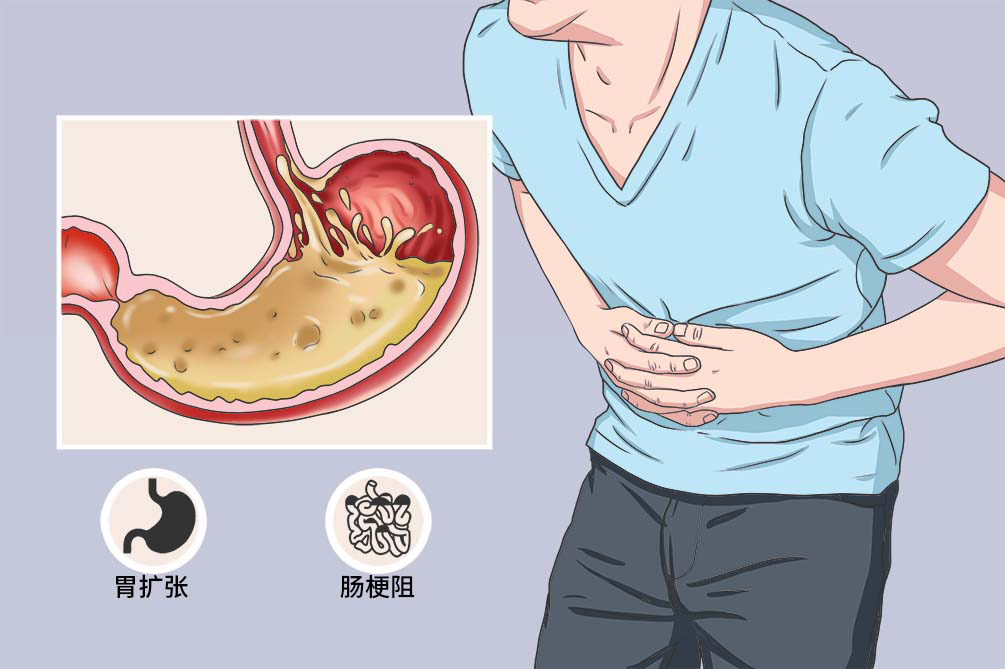 儿童幽门梗阻图片