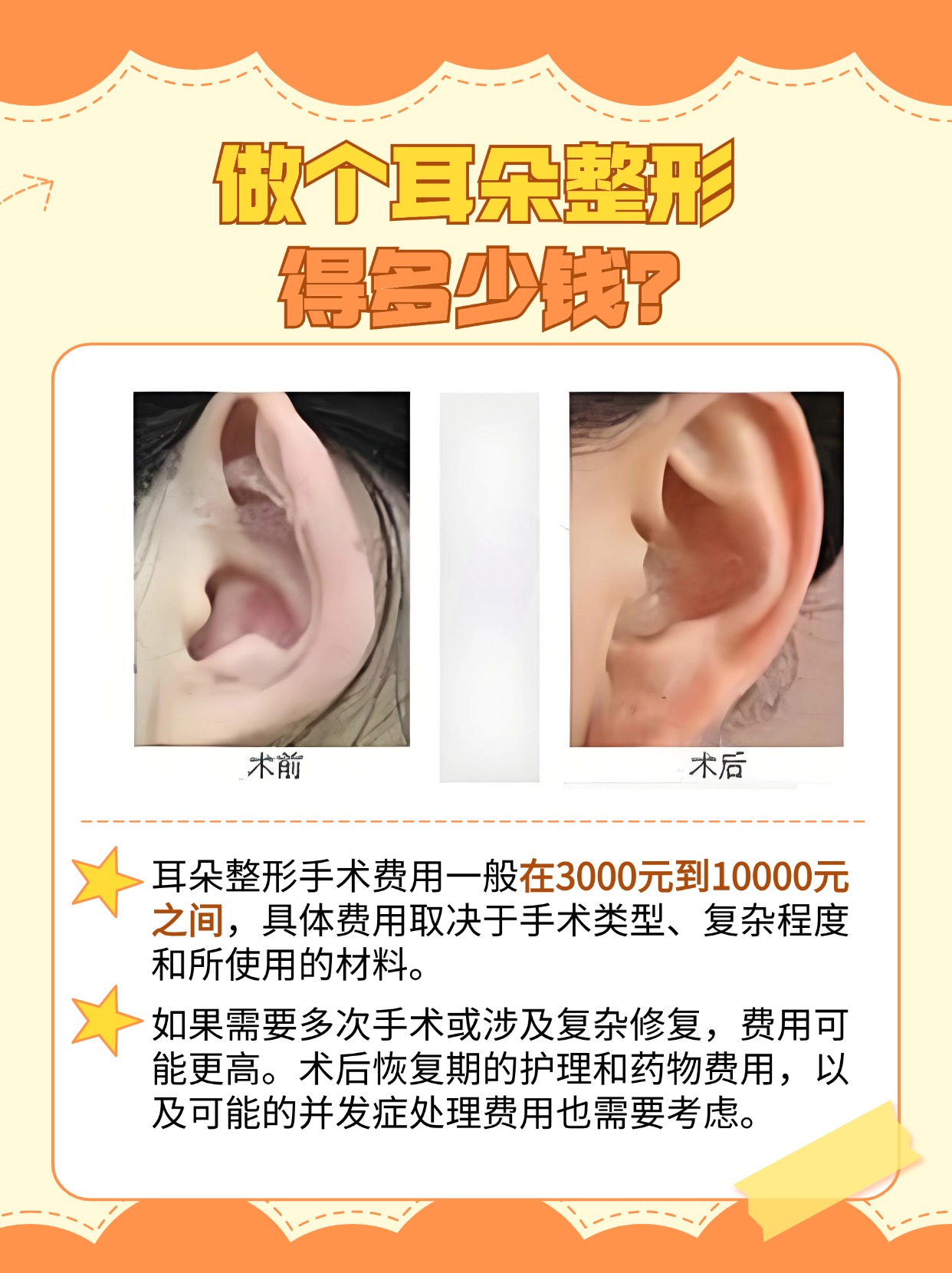 耳朵整形费用解析:手术价格大公开