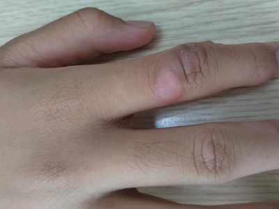 人工皮炎的症状和图片 - 有来医生