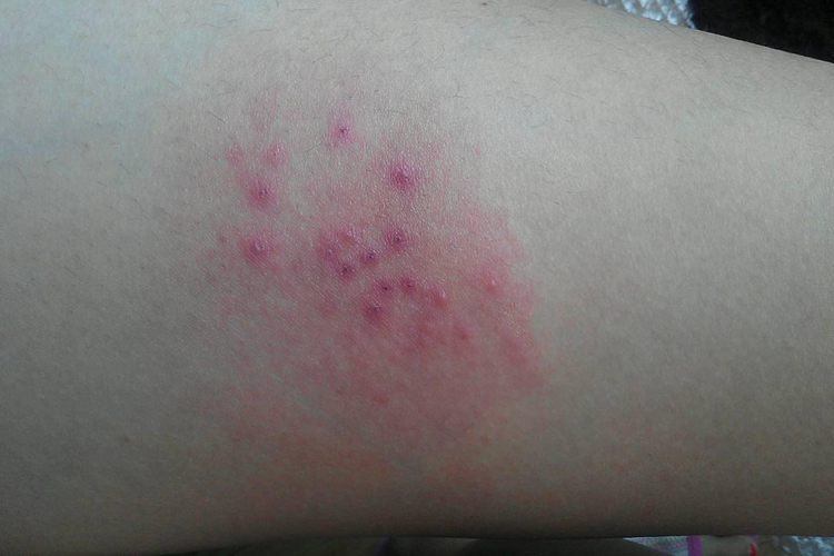 接触性皮炎小腿红点图