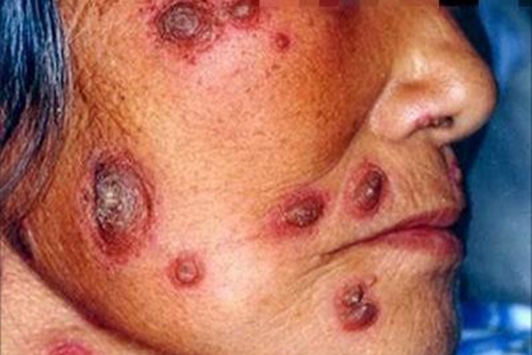 天疱疮面部大红疙瘩图 天疱疮面部大红疙瘩图
