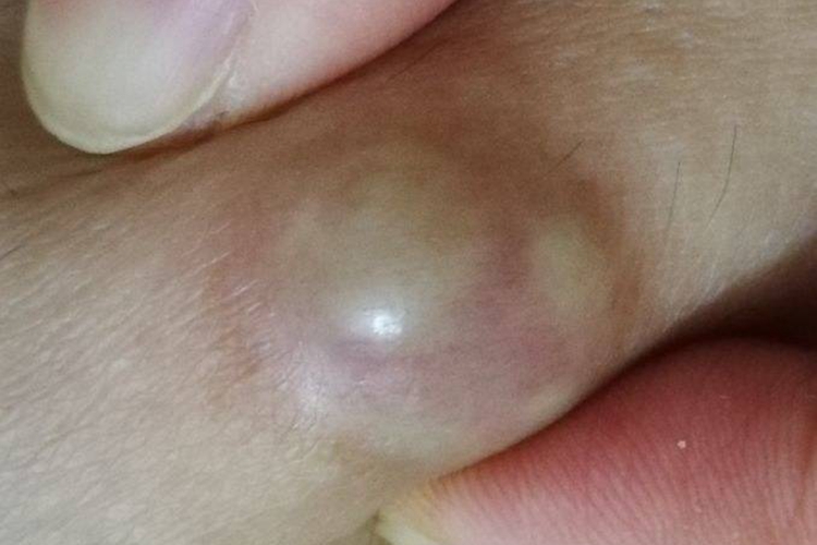 手部皮脂腺囊肿图 手部皮脂腺囊肿图