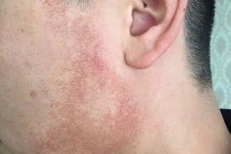 毛发苔藓面部斑图