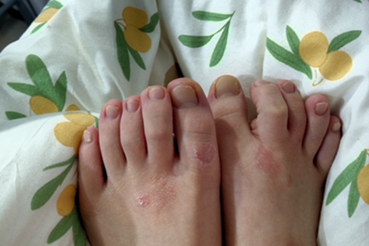 慢性湿疹脚背图