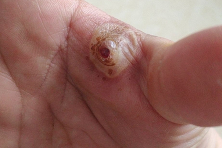 化脓性肉芽肿大疙瘩图 化脓性肉芽肿大疙瘩图