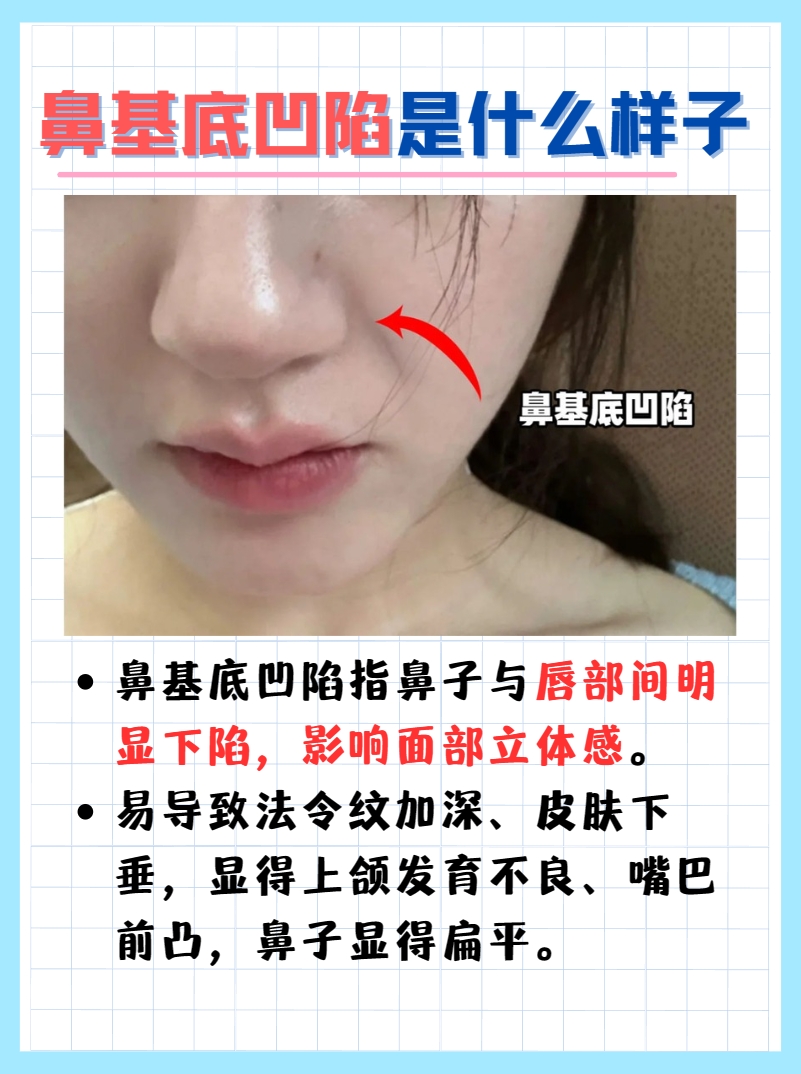 这篇文章带你了解，鼻基底凹陷是什么样子