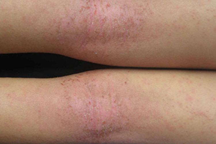 儿童期特应性皮炎腘窝皮肤粗糙图