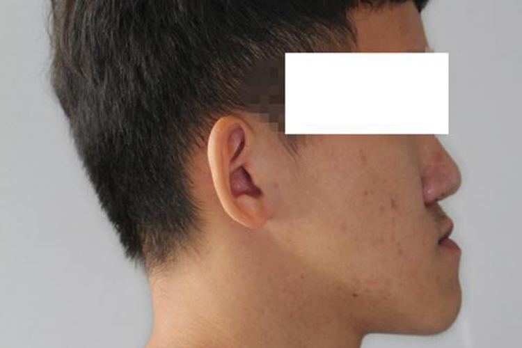 下颌前突严重骨性嘴凸图