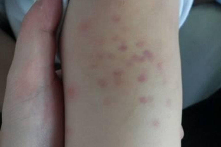 先天性风疹综合征胳膊症状图