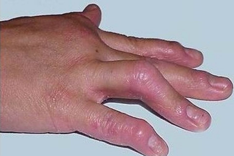 复发性风湿病手部症状图 复发性风湿病手部症状图