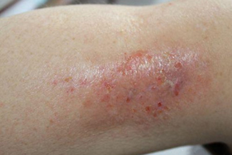 急性湿疹胳膊红斑结痂图