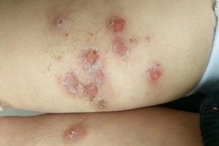 深脓疱疮大腿糜烂图