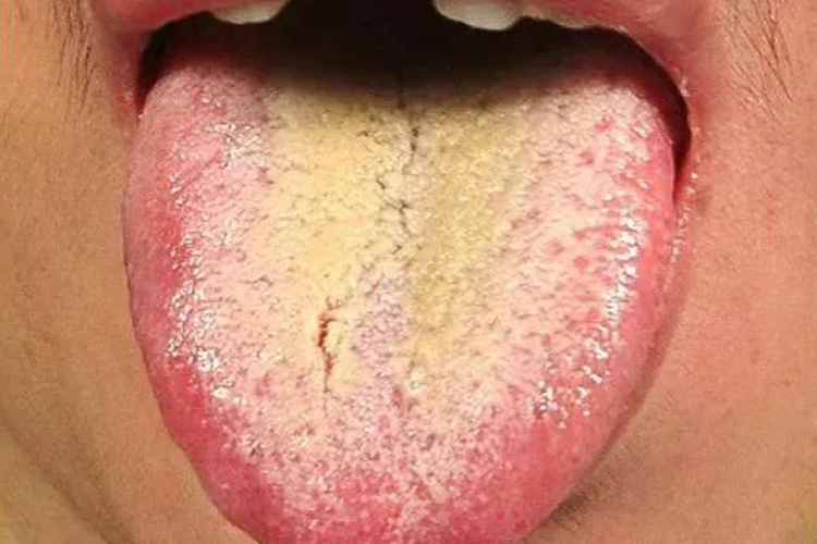 湿热困脾舌苔图