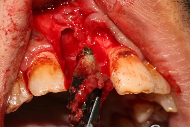 牙根囊肿拔除病牙图 牙根囊肿拔除病牙图