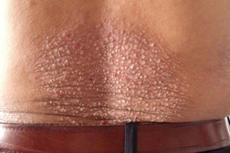 继发性皮肤淀粉样变腰部丘疹图 继发性皮肤淀粉样变腰部丘疹图