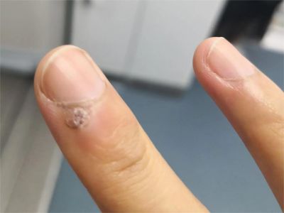 寻常疣手指甲周围有硬疙瘩表面粗糙图