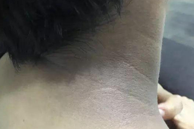 黑变病颈部皮肤发黑图