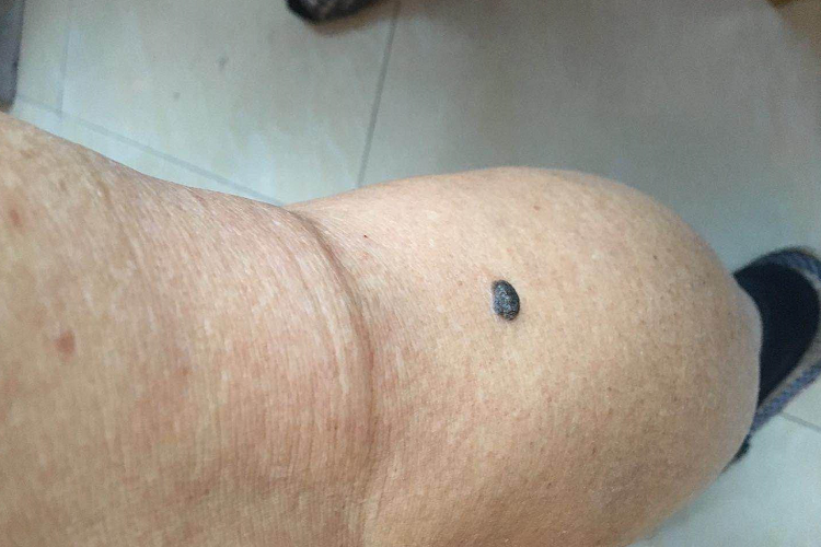 黑疙瘩样恶性黑色素瘤图