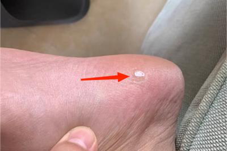 胼胝脚后跟有硬块图