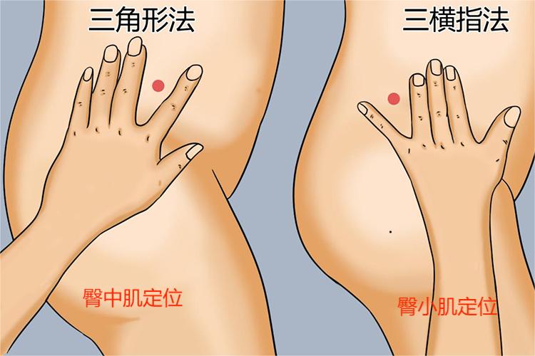 臀中肌臀小肌定位图