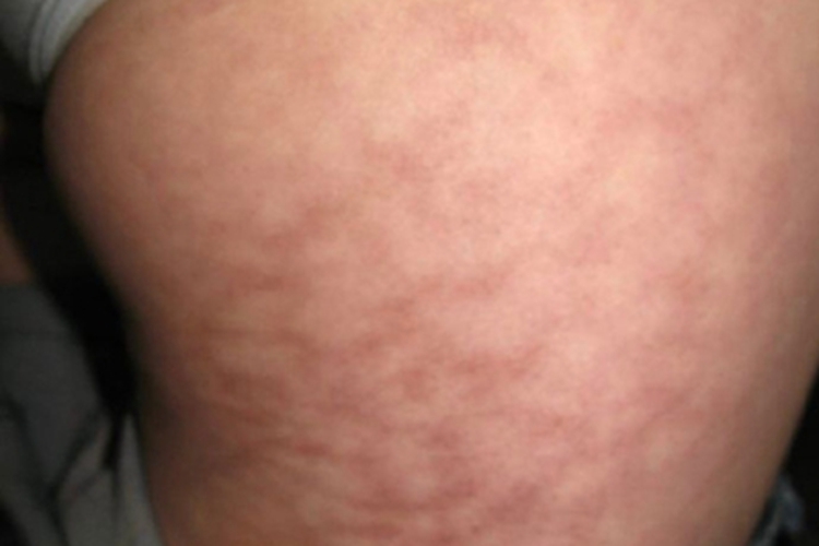 火激红斑大腿红斑图