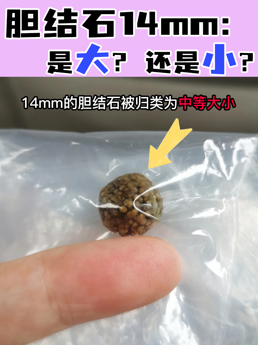 胆结石14mm：是大？还是小？