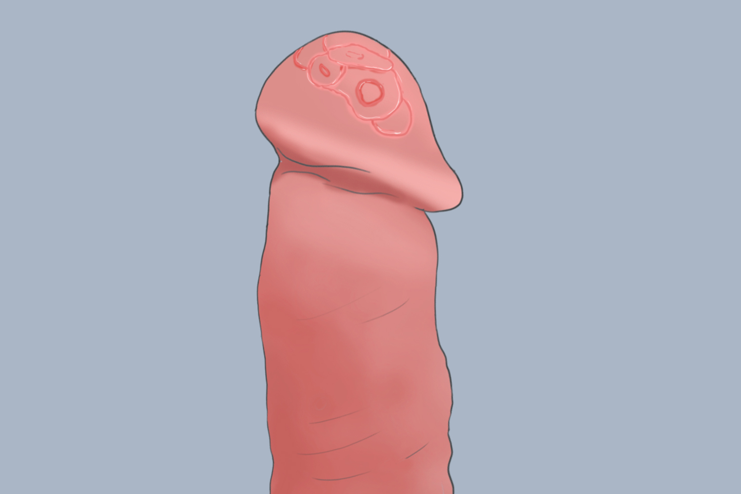 龟头长癣图 龟头长癣图