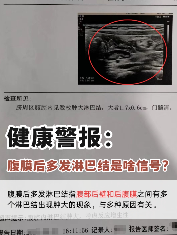 健康警报：腹膜后多发淋巴结是啥信号？