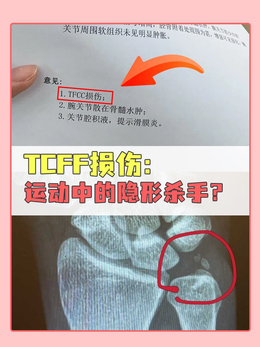 TCFF损伤:运动中的隐形杀手?