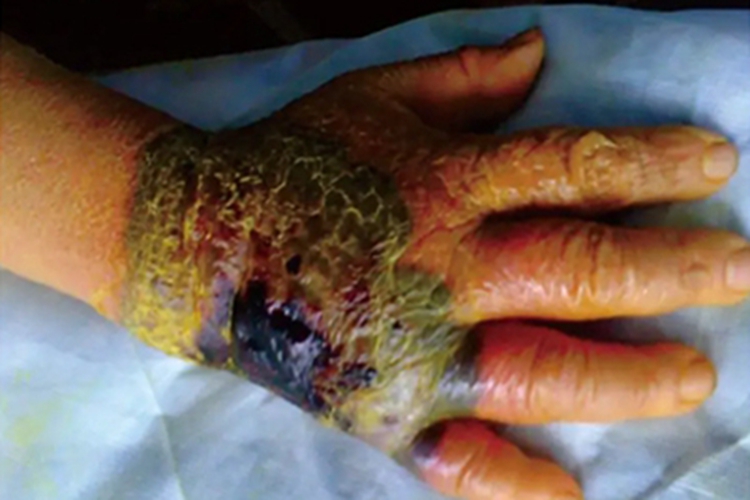 蜂窝织炎手部结痂图