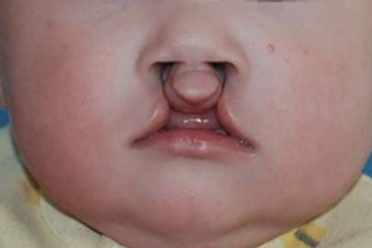 先天性外胚叶发育不良唇裂图