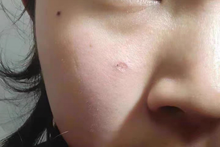 交界痣脸上有一个黑痣图