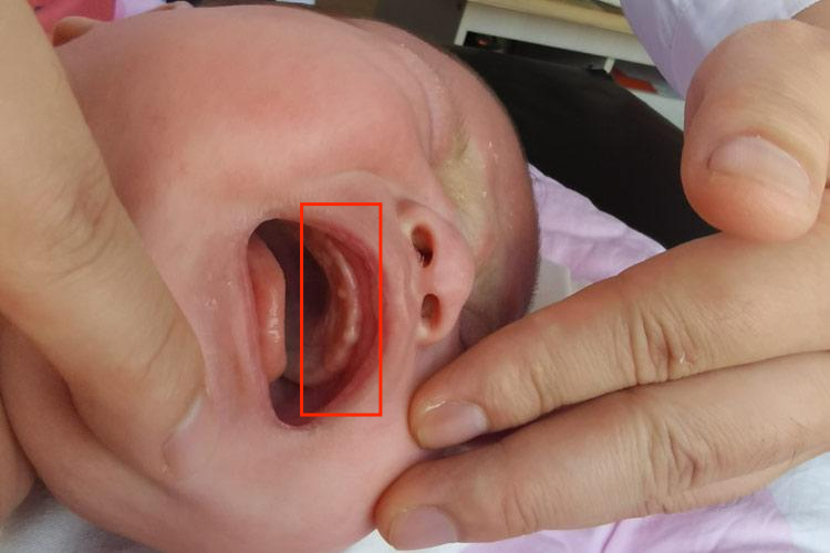 上牙龈处的马牙图 上牙龈处的马牙图