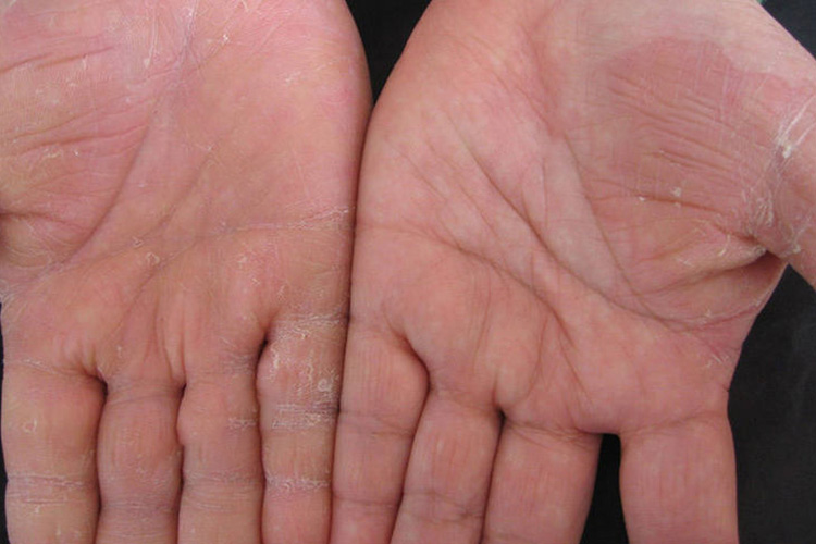 掌跖部早期鳞屑角化型手癣图