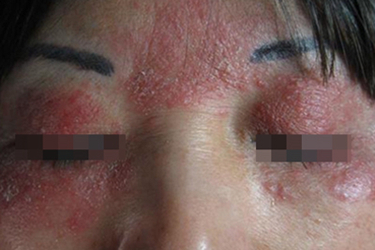 面部变应性接触性皮炎面部红斑图