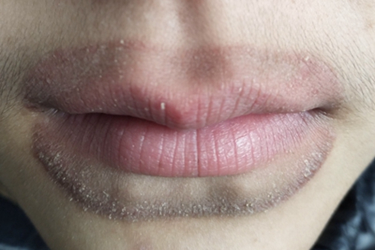 接触性唇炎口周脱屑图 接触性唇炎口周脱屑图