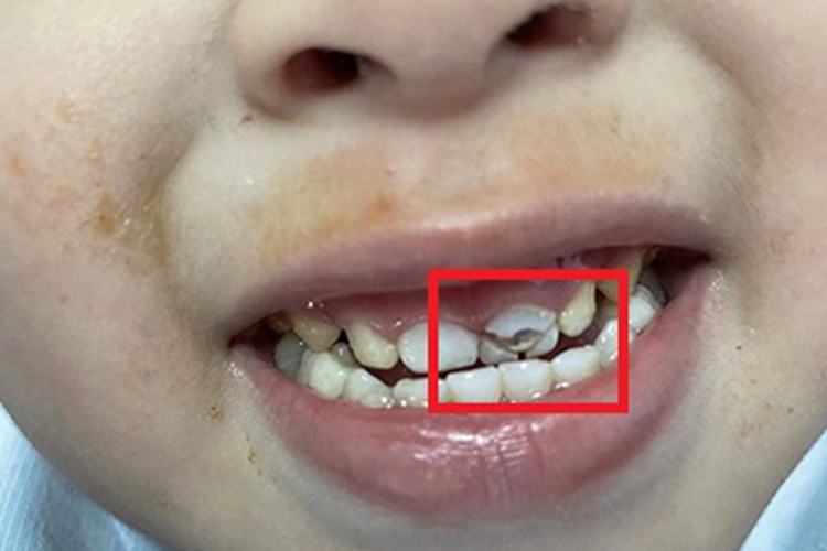 牙外伤牙齿症状图