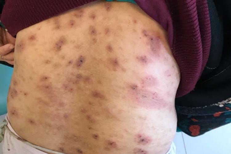 重型多形红斑型药疹红斑图