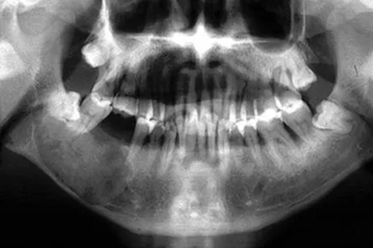 牙瘤X线图